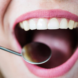 Diş Beyazlatma Doktor Kontrolünde Nasıl Olur?