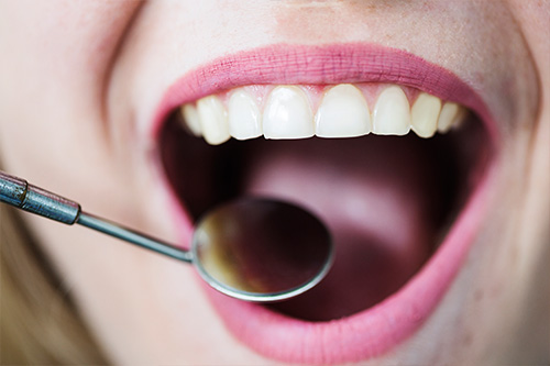 Diş Kırılması Nasıl Tedavi Edilir?
