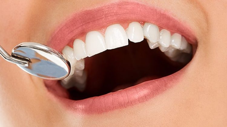 Diş Eti Çekilmesi Tedavisi Nedir?
